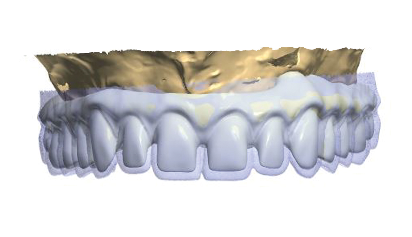 The use of CBCT and CAD/CAM techniques in implant-supported ...