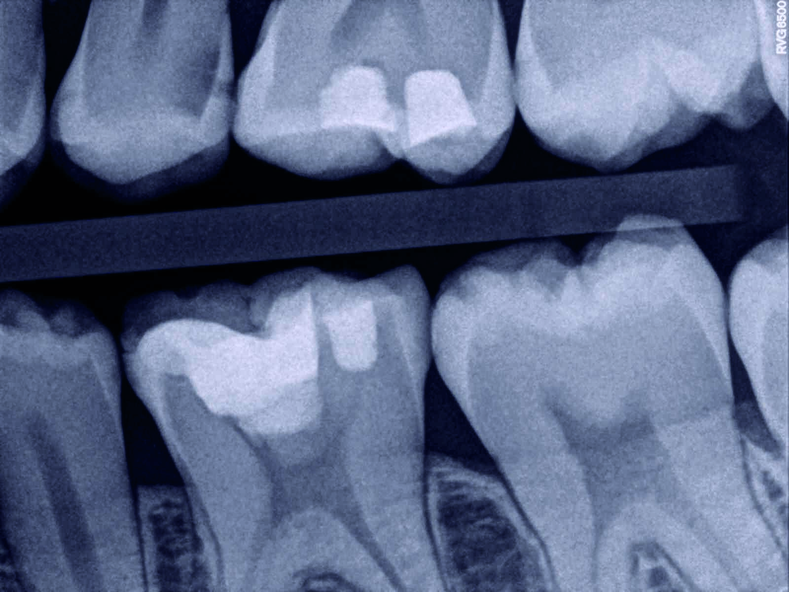 Direct pulp capping as a conservative procedure to maintain pulp vitality