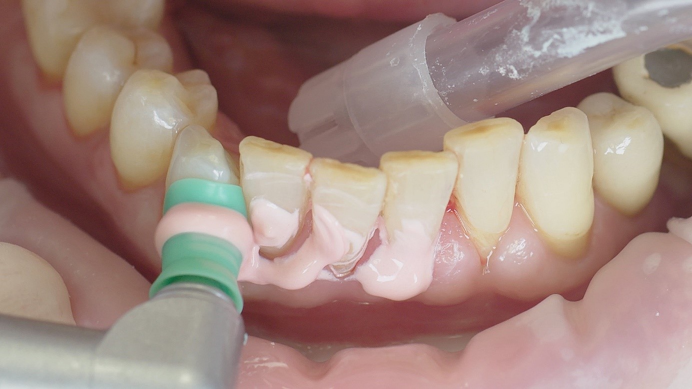 Implants should only be inserted when periodontal conditions are stable