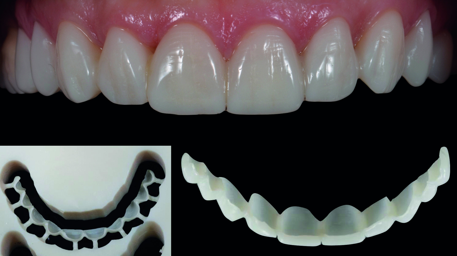 Dental News - Digital vs. analogue workflow on ten ceramic veneers in ...