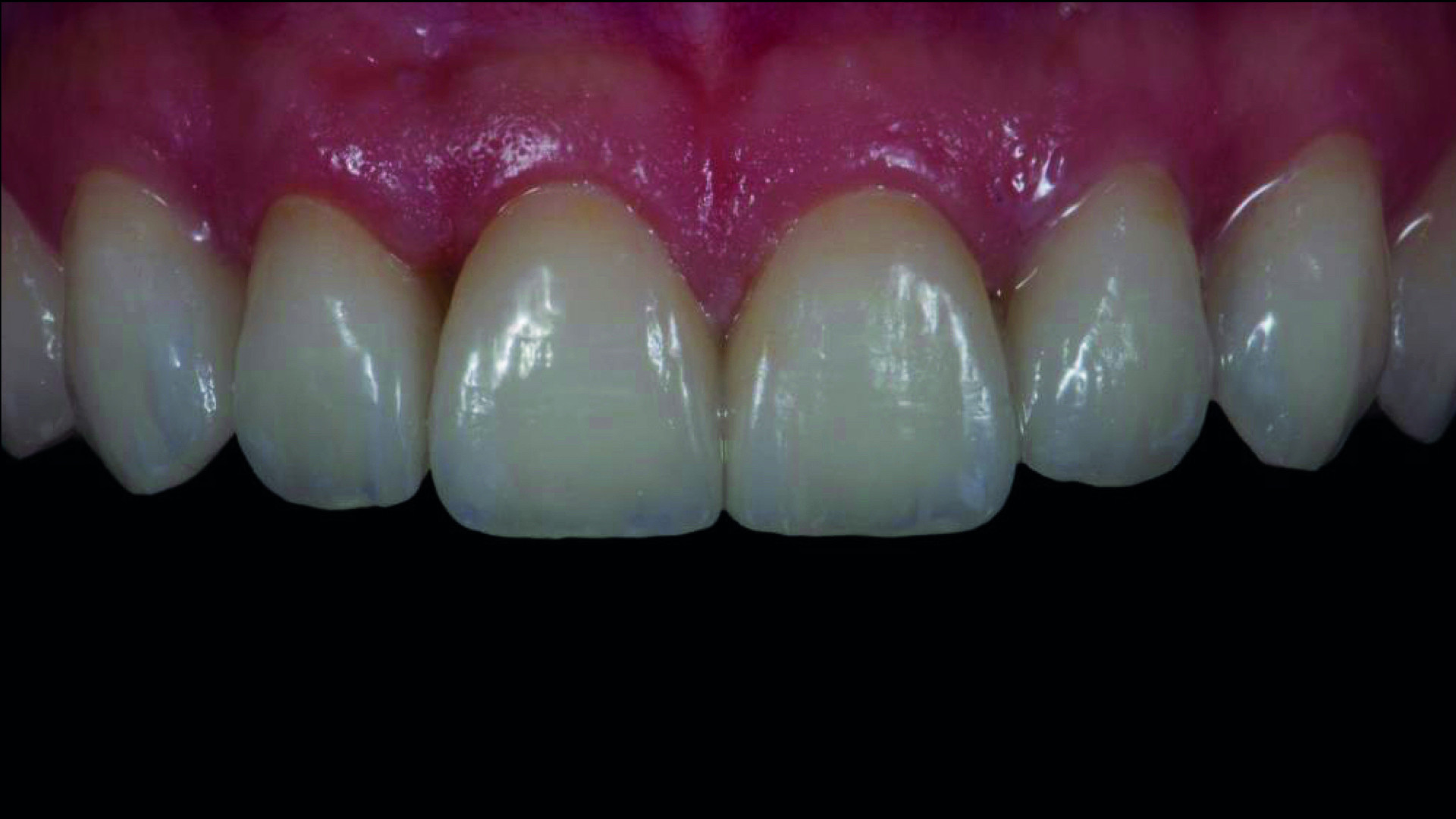 Dental News - Digital vs. analogue workflow on ten ceramic veneers in ...