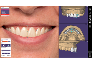 exocad-product-smile-creator