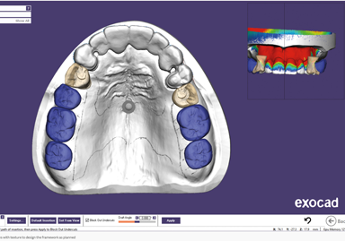 product-exocad-partialCAD