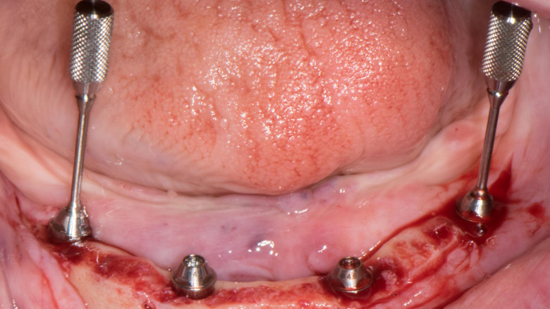 Straumann Pro Arch concept with fully guided implant and abutment placement