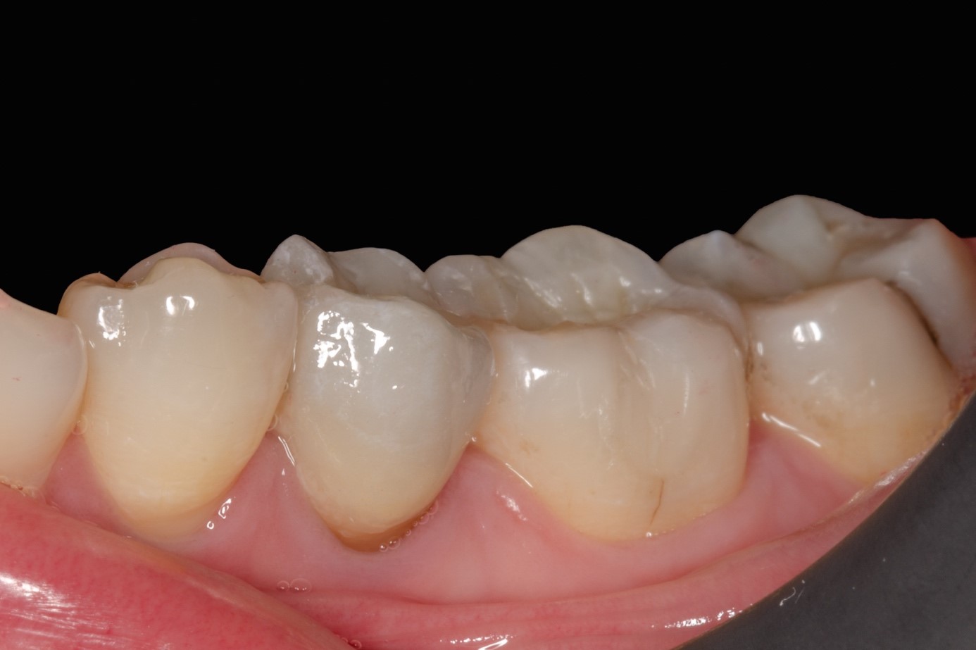 Daily aesthetic dentistry The contribution of the spectrophotometer