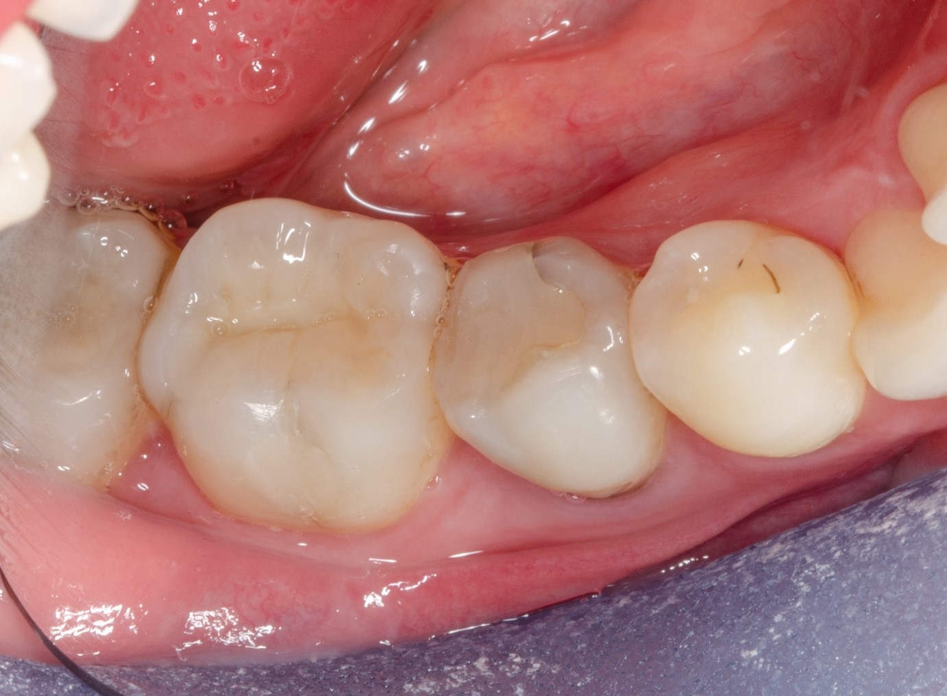 Daily aesthetic dentistry The contribution of the spectrophotometer