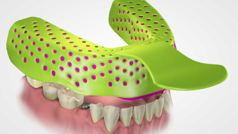 Study compares accuracy of open and closed dental implant