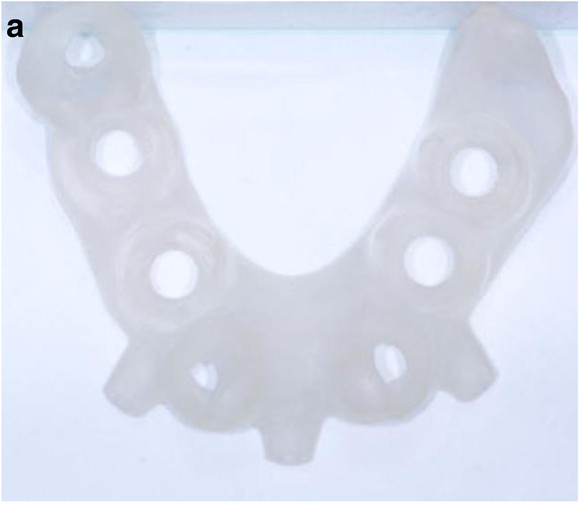 Dental News - Computer-aided, template-guided immediate implant ...