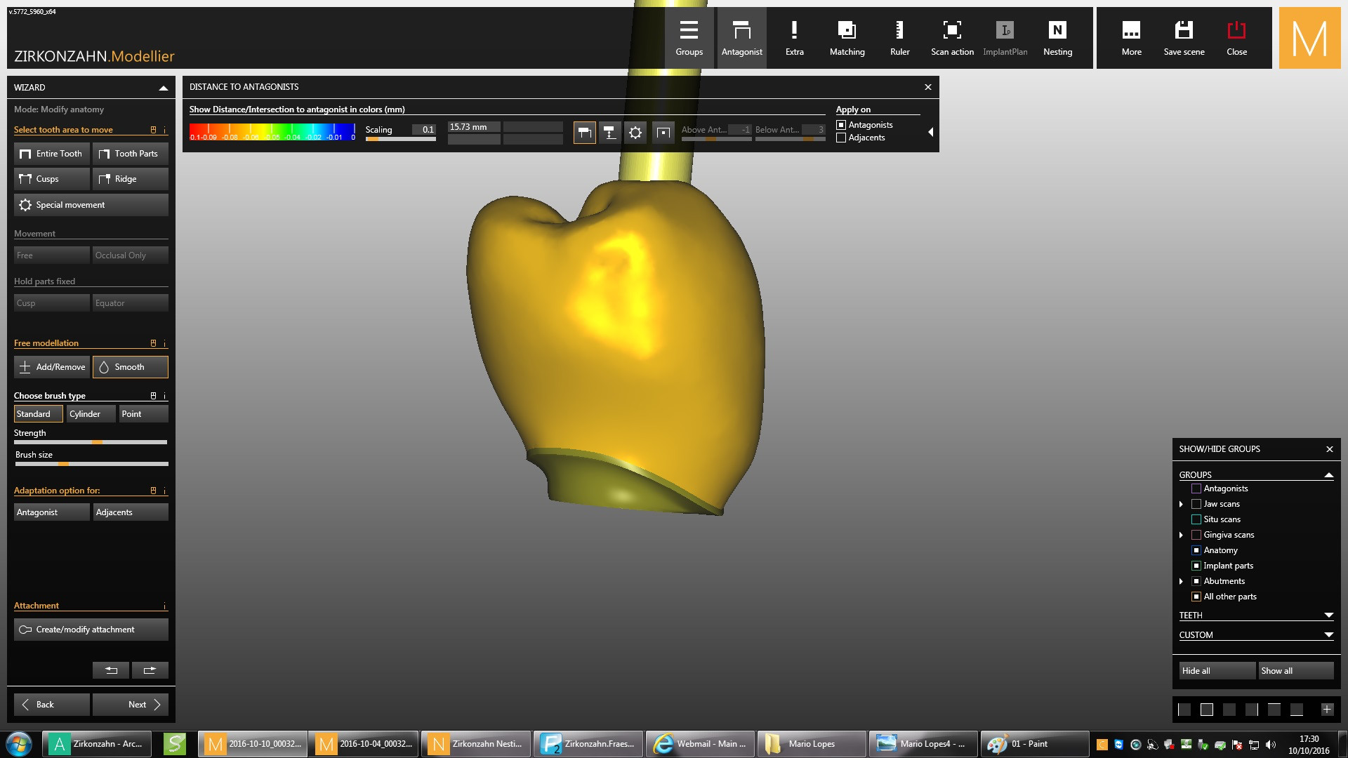 Dental News - Immediate loading of a socket shield post-extraction ...