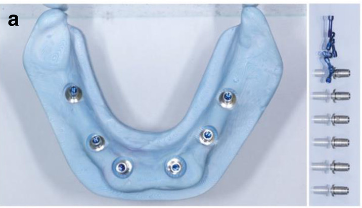 Dental News - Computer-aided, template-guided immediate implant ...