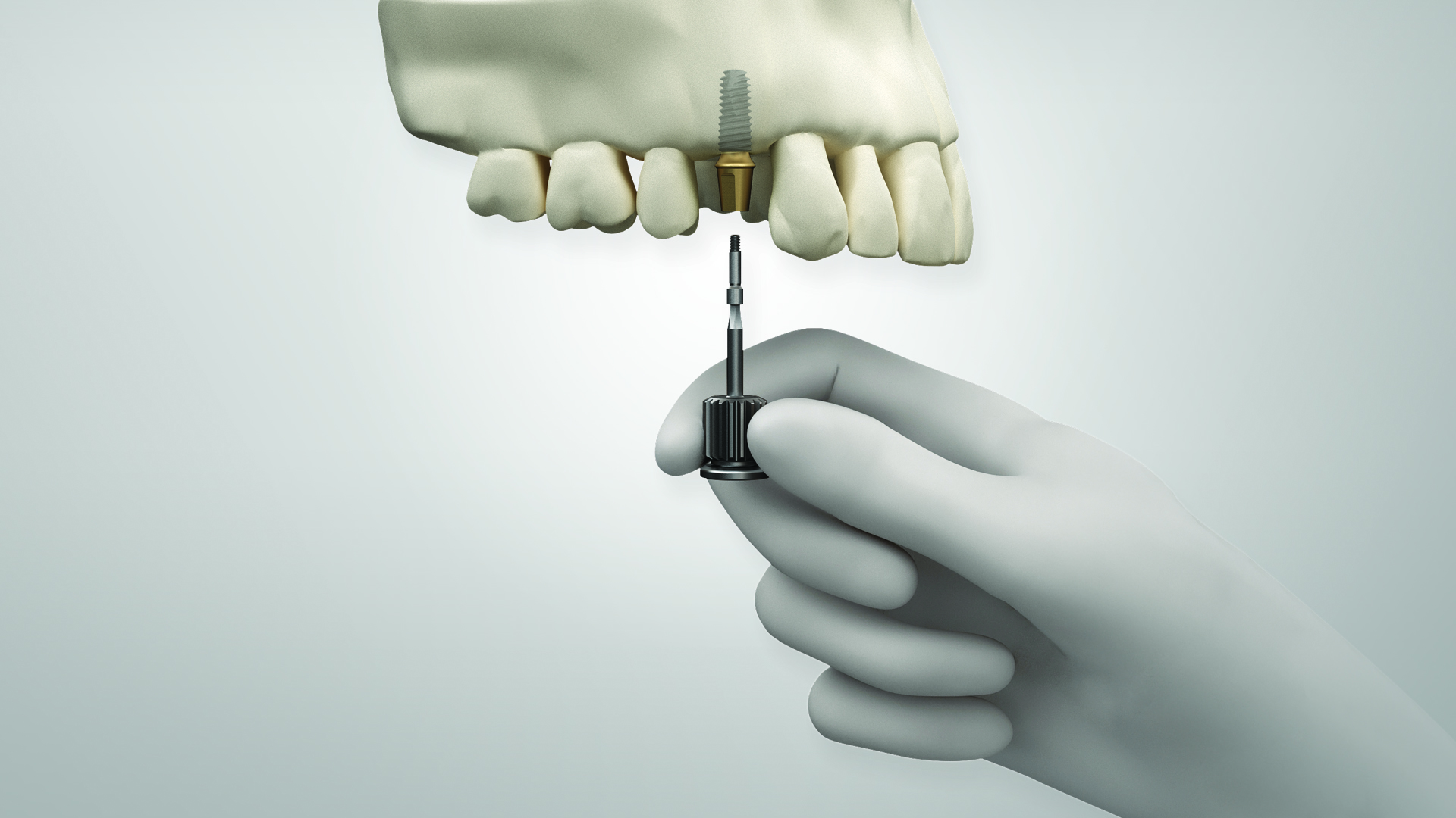 The KS implant system offers single-handed use. (Image: Osstem Implant)