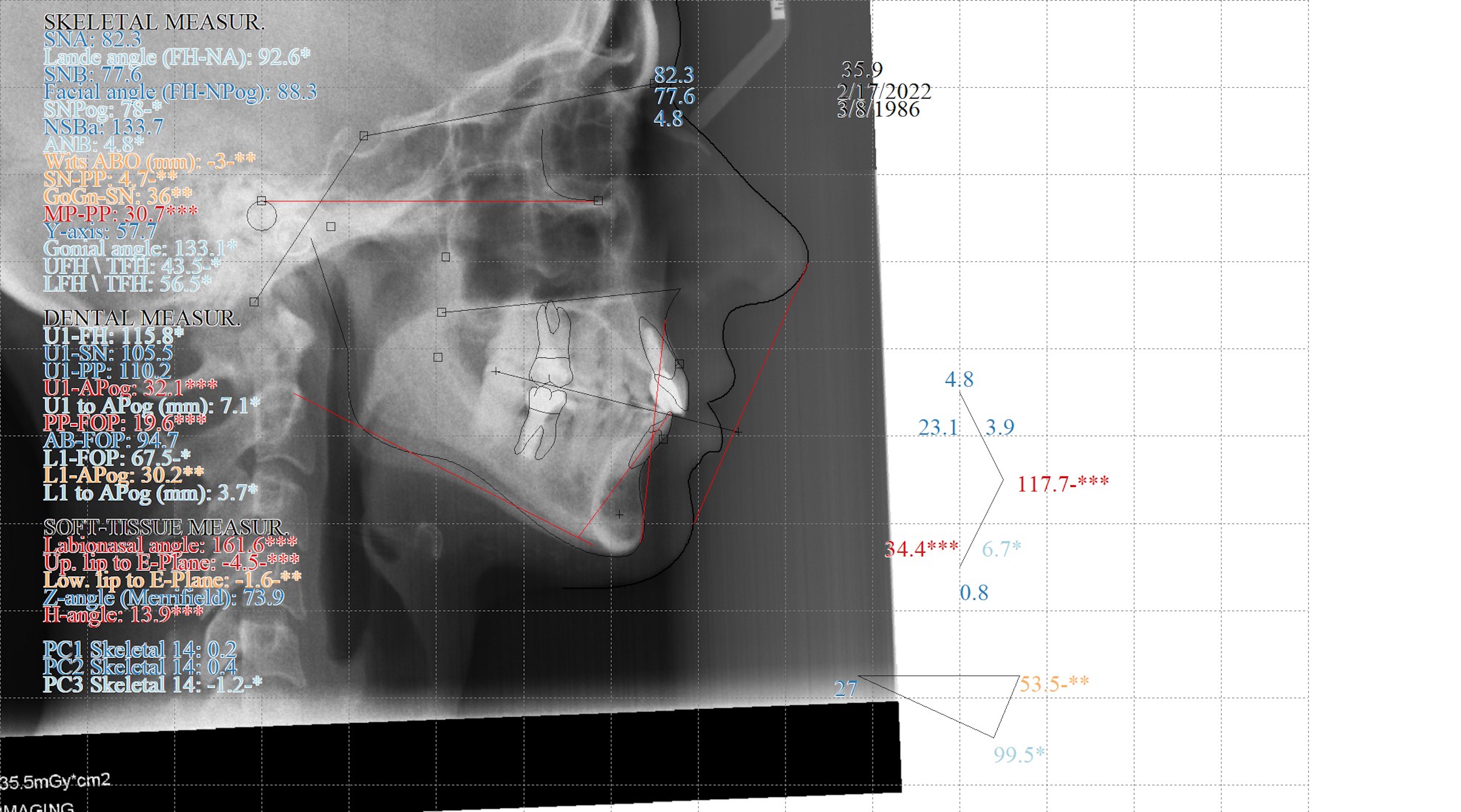 Fig. 16: Final cephalometric radiograph and analysis.