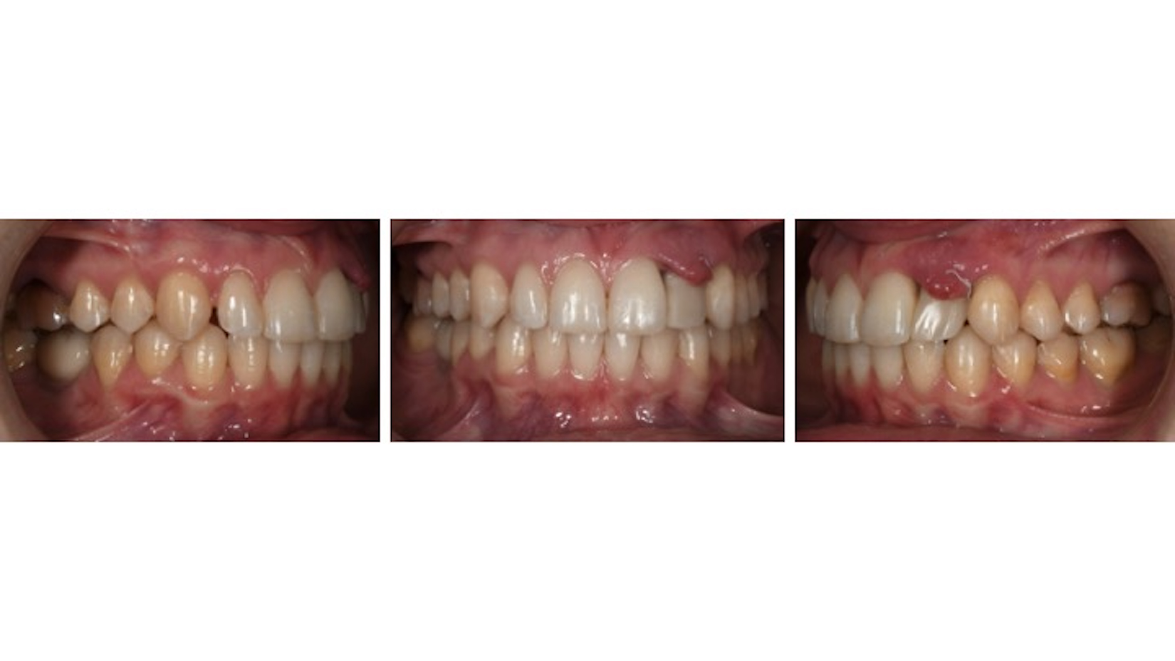 Figs. 10a–c: Lateral and frontal intra-oral photographs after orthodontic treatment and implant placement. Tooth #12 had not yet been prosthetically restored.