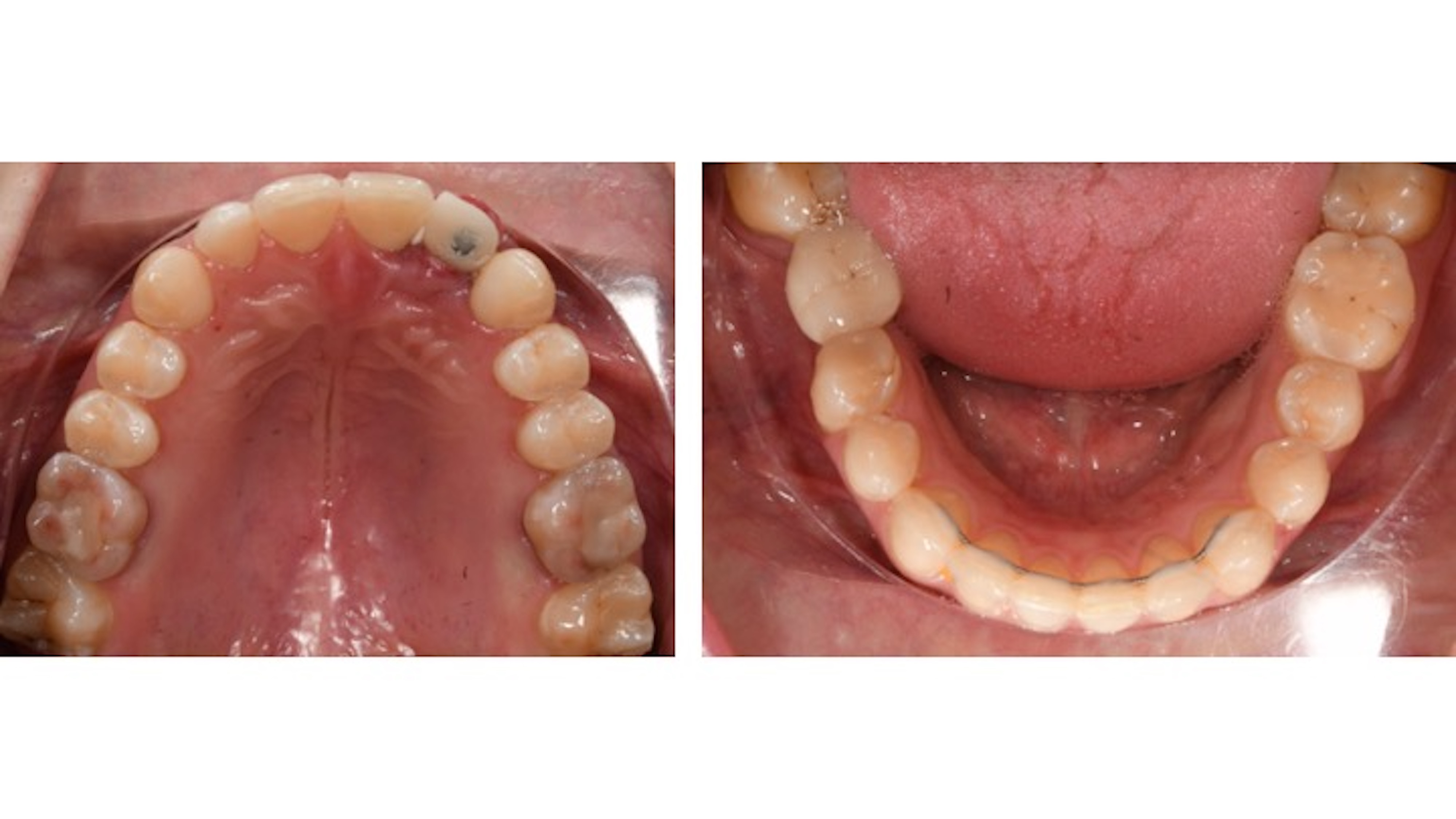 Figs. 11a & b: Occlusal photographs after orthodontic treatment.