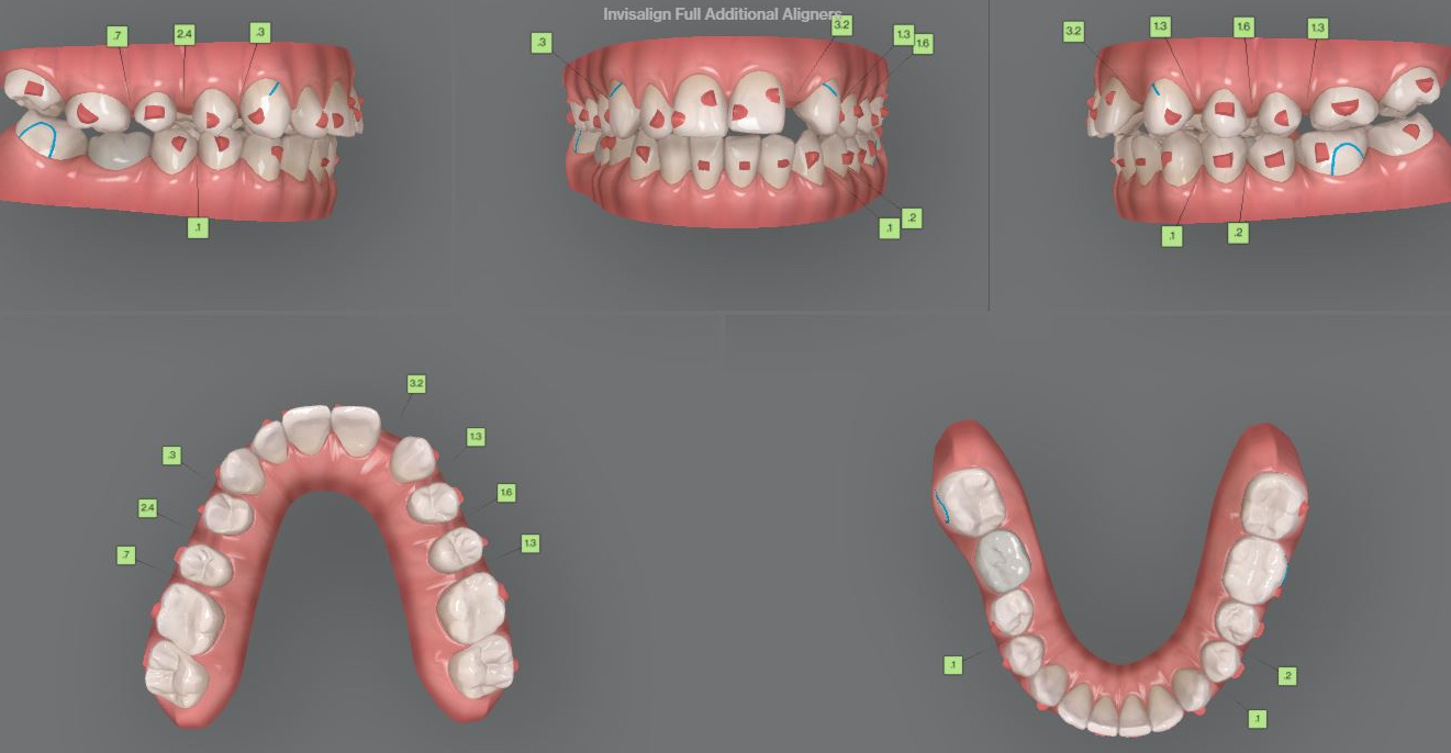 Fig. 7: Mid-treatment intra-oral situation.