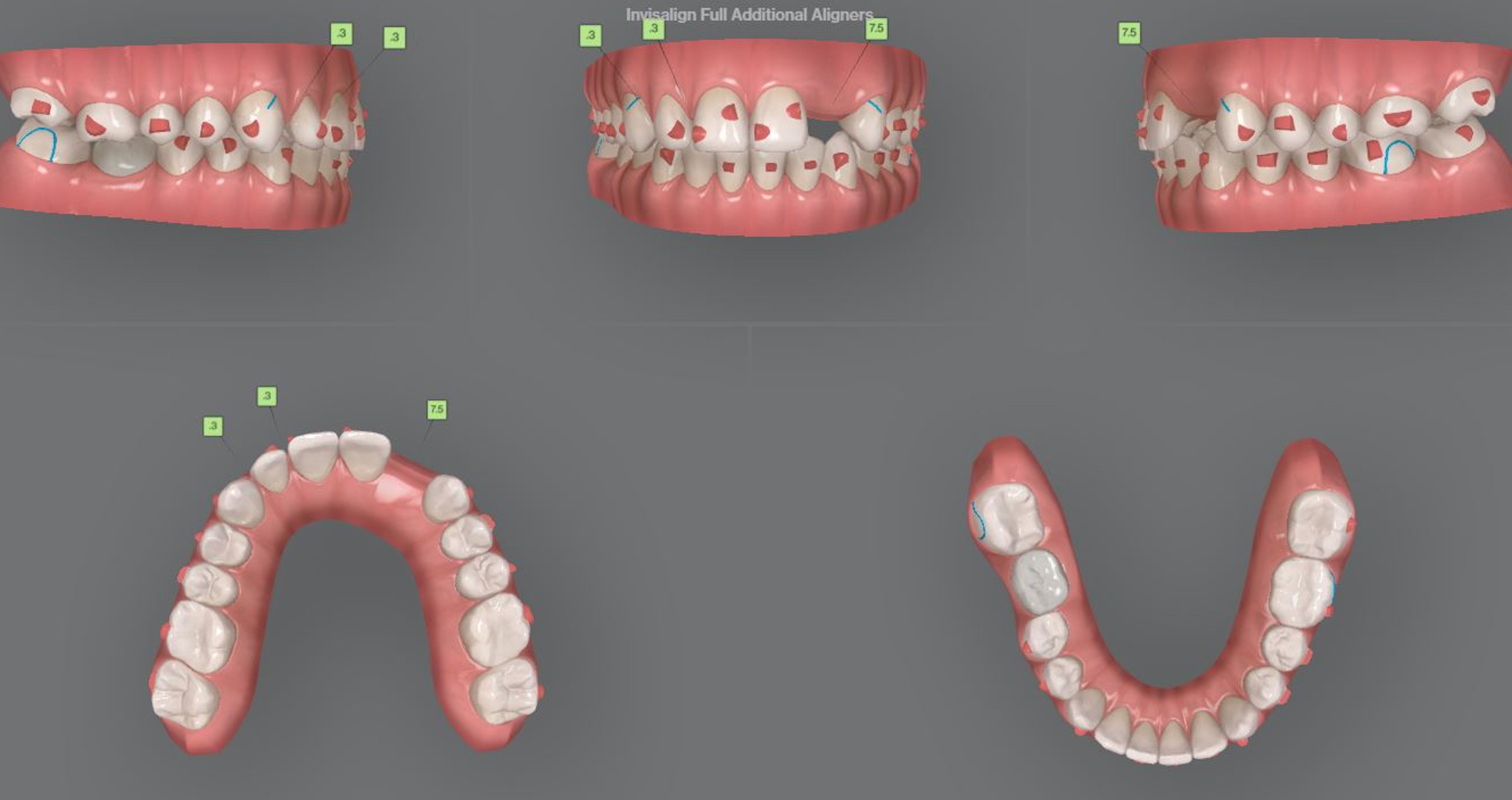 Fig. 8: Additional aligners ordered.