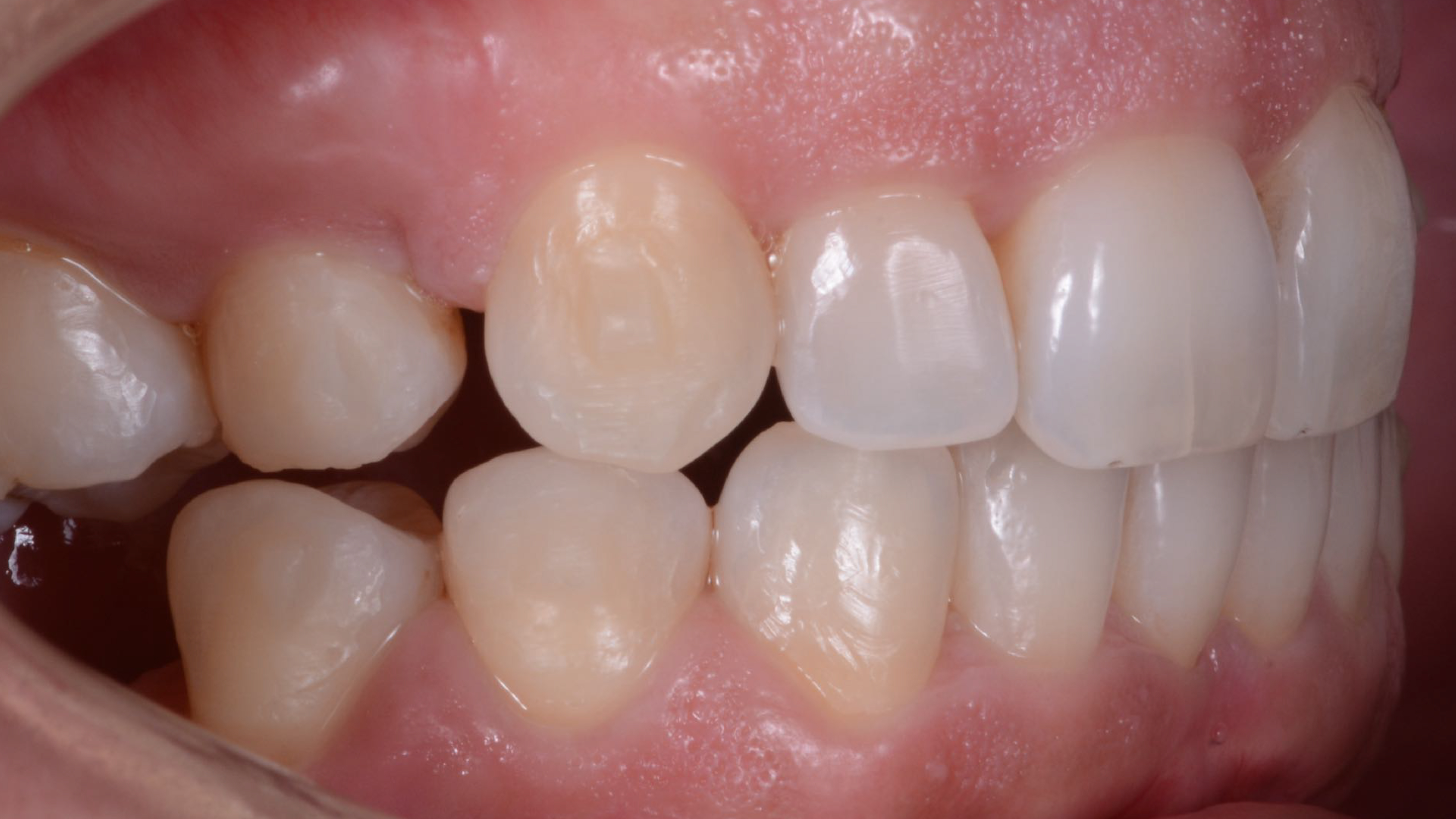 Fig. 2: Large gaps between the teeth caused by poor orthodontic planning.