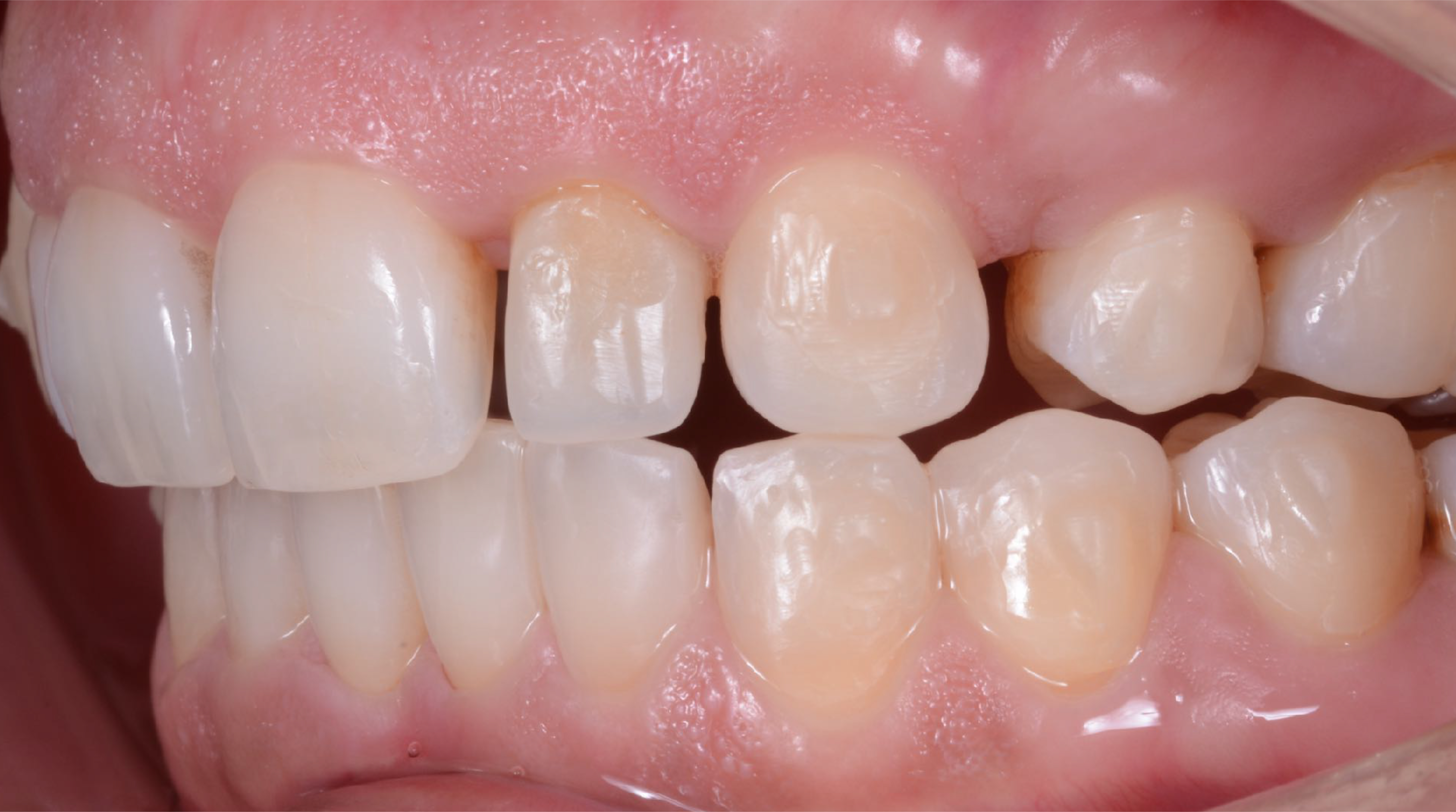 Fig. 3: Grandes espaços entre os dentes causados por um planeamento ortodôntico deficiente.