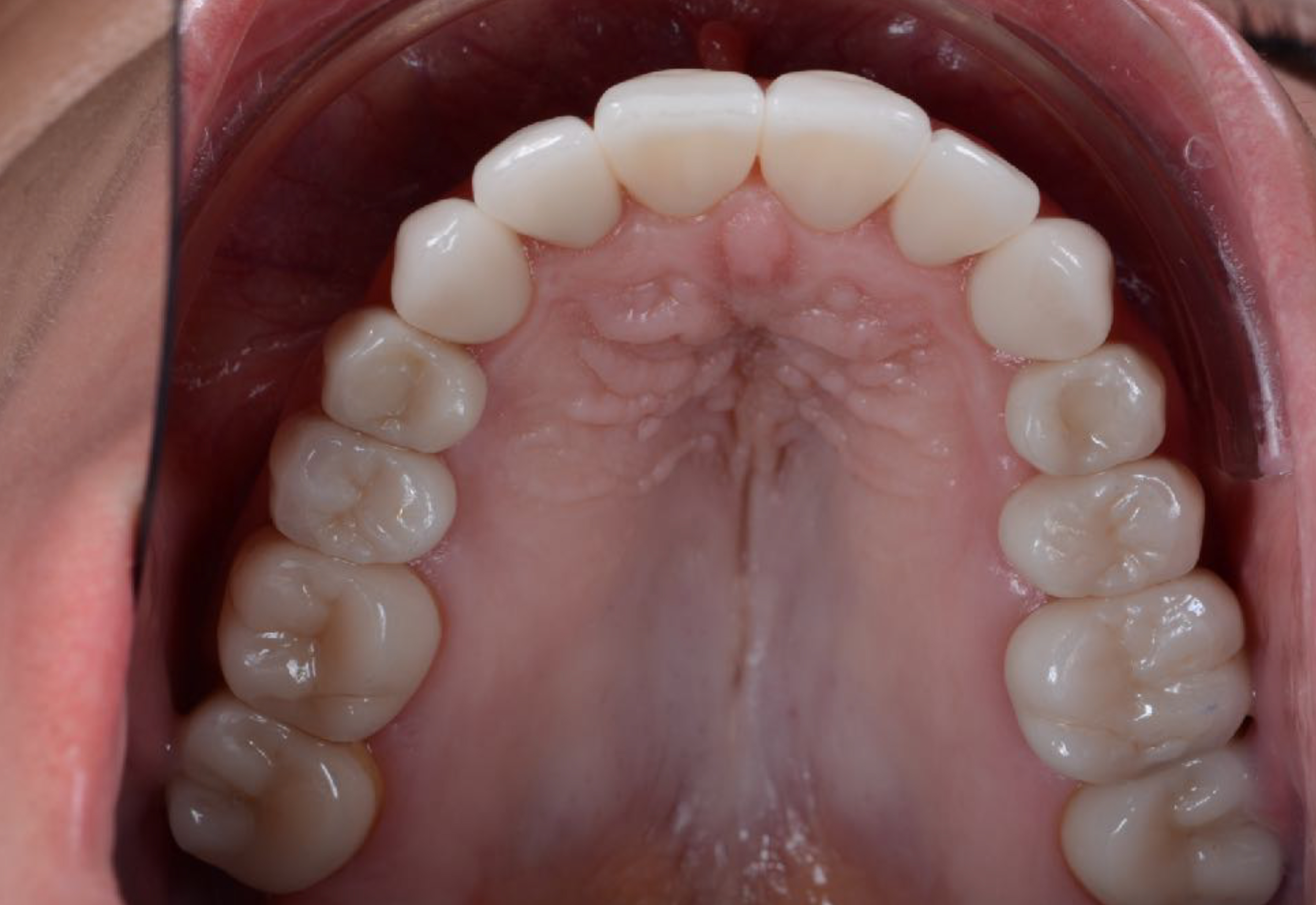 Fig. 5b: ...and after implant and final ceramic restorations. 