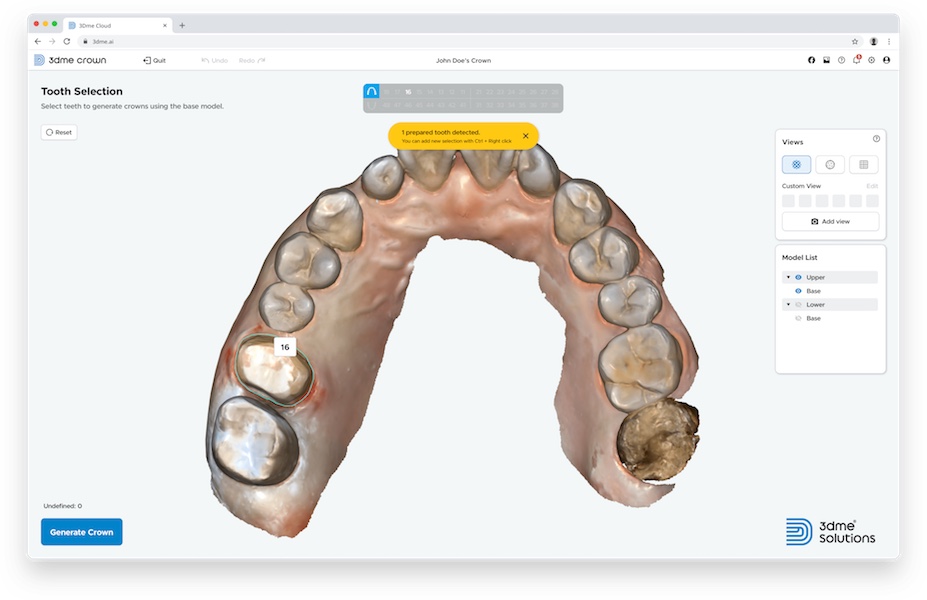 The 3Dme Crown software automatically identifies the margin between the tooth and gingiva of the crown to be manufactured and suggests an optimised margin. (Image: Imagoworks)