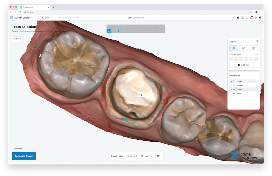 The software’s AI allows it to suggest a crown design optimised for the patient’s oral environment through deep learning. (Image: Imagoworks)