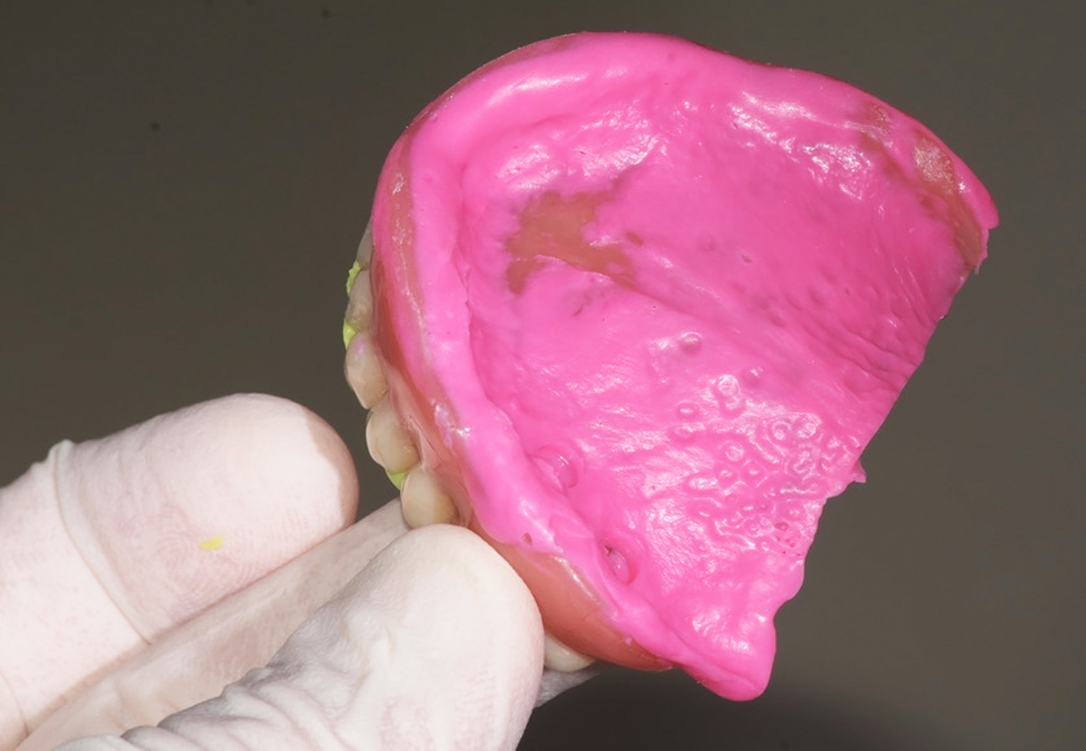 Fig. 4: Taking of the maxillary impression with the existing denture.