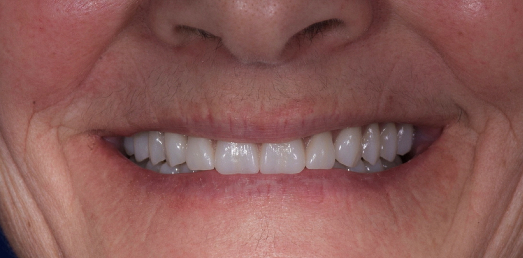 Fig. 25: Individualised, digitally produced complete maxillary and mandibular dentures in situ, smiling (CediTEC).