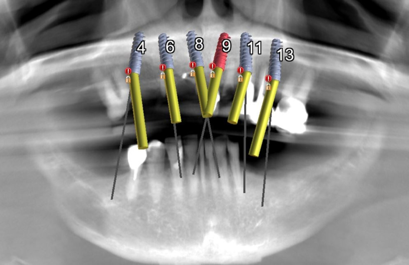 Fig. 3a: Six implants planned for maxillary arch fixed restoration.