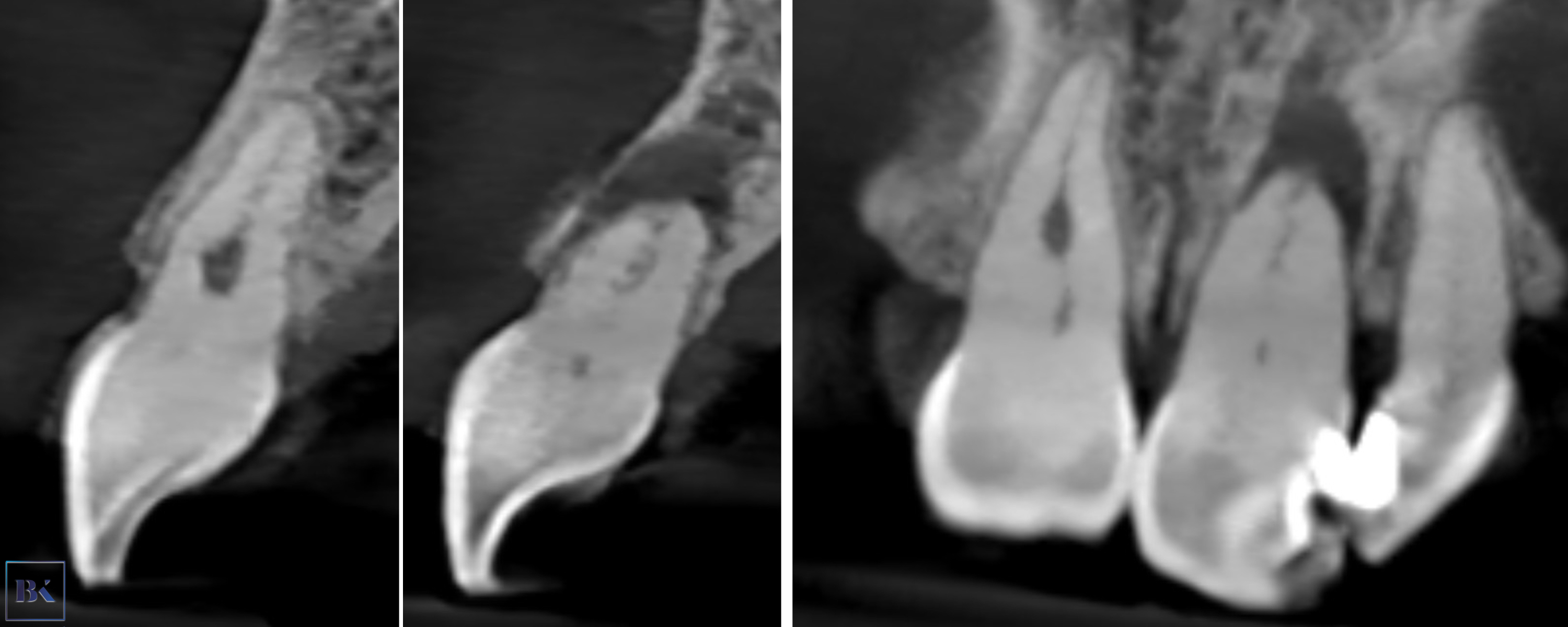 Figs. 15a–c: CBCT scan, sagittal (a & b) and coronal planes (c). Pulp canal obliteration was visible in both teeth, and a periapical lesion was present around the left incisor. Internal resorption in the right incisor was suspected.