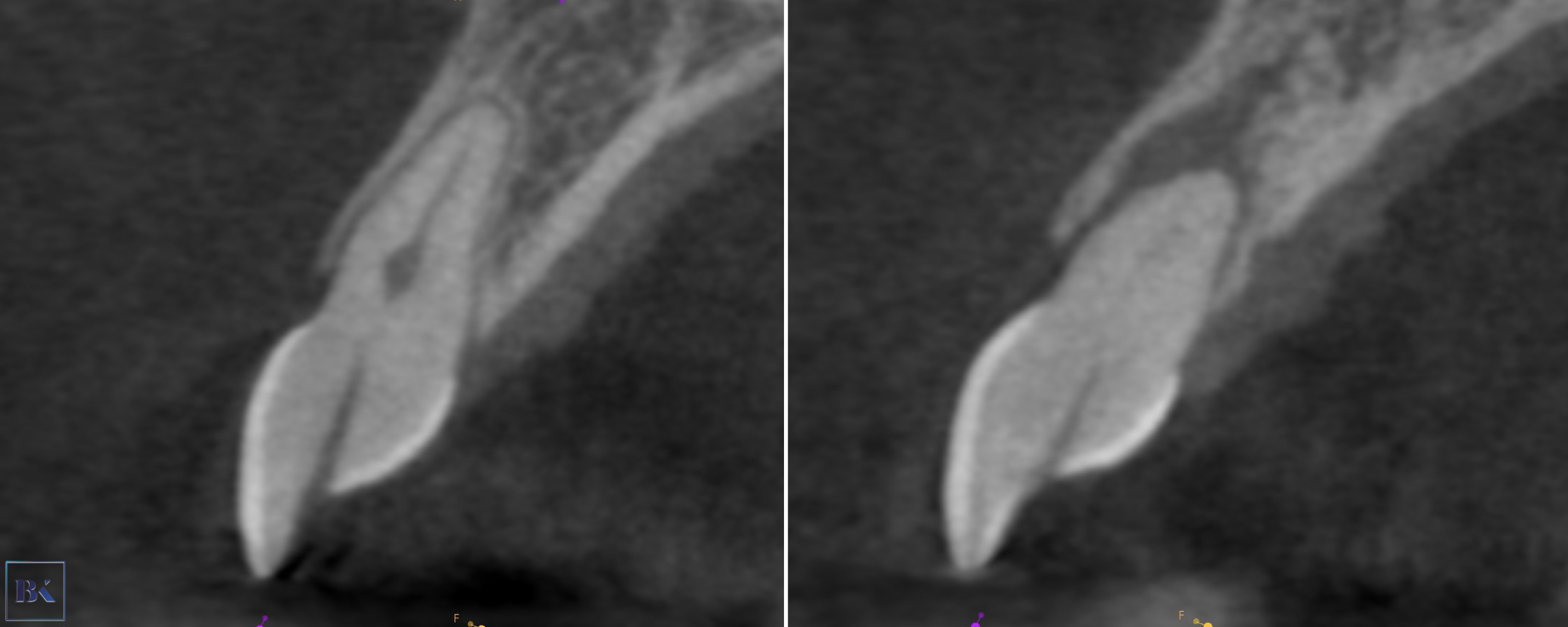 Figs. 18a & b: CBCT check, sagittal plane. The axis of the access cavity was visible for both teeth.