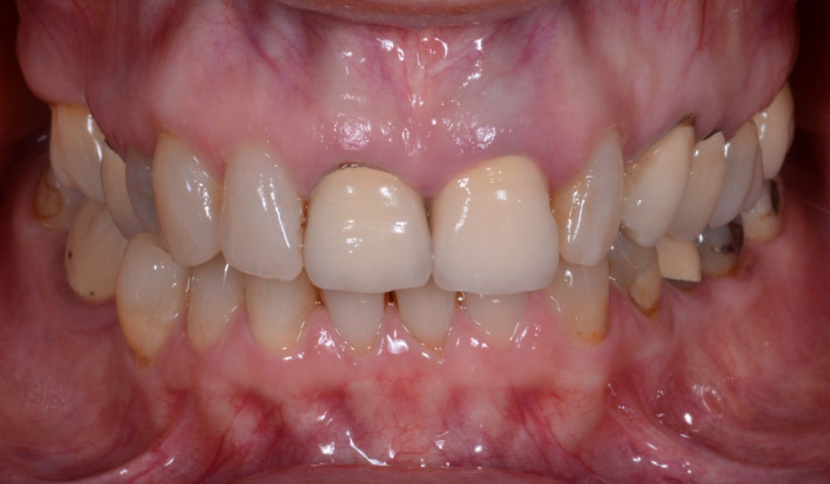 Fig. 2: Frontal intra-oral view of the patient’s teeth.