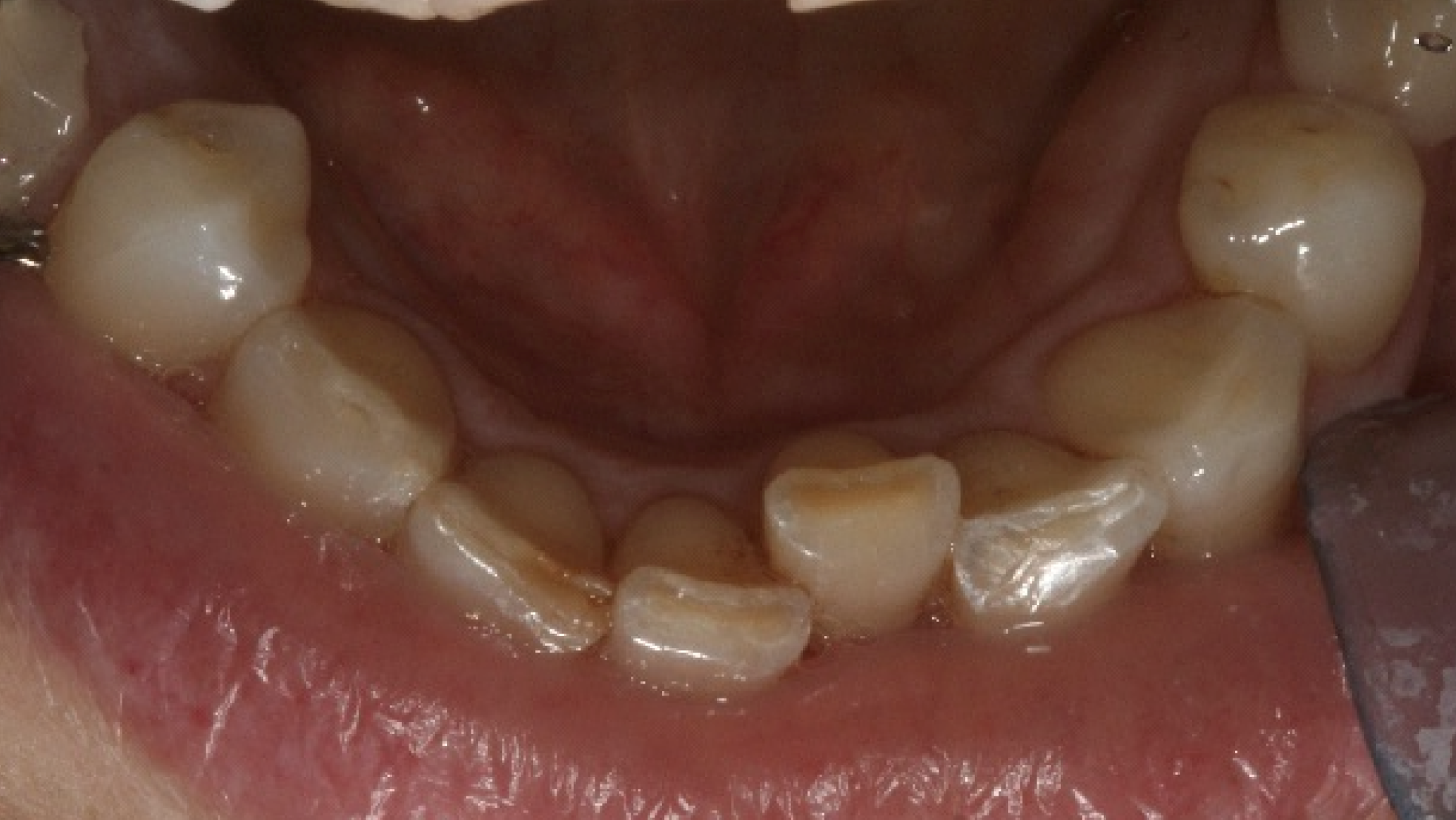 Fig. 3: 2004—wear on the mandibular teeth and crowding.