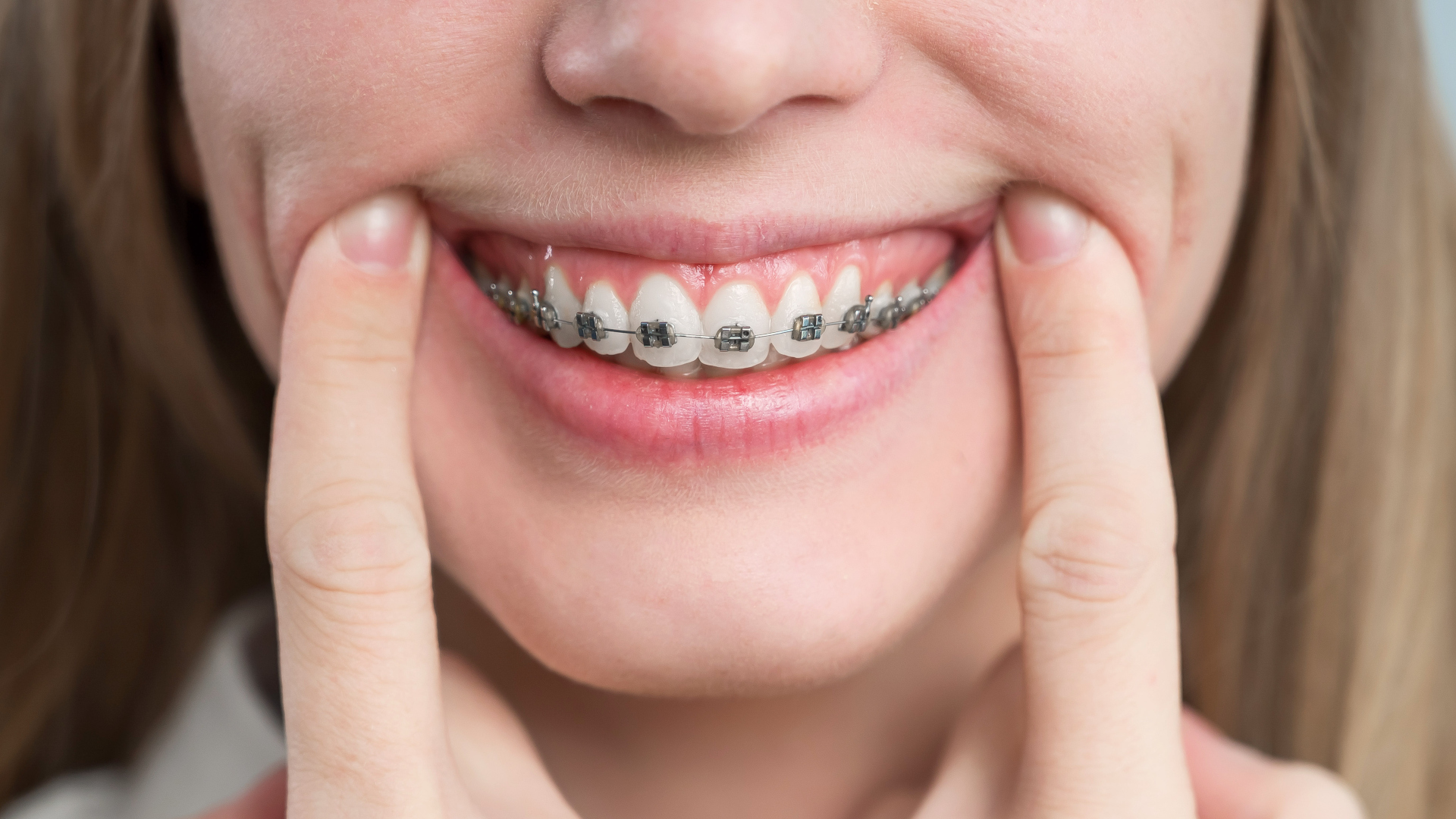 Dental News - Perio-ortho synergy: “Excellent periodontal health